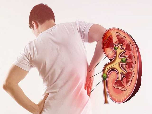 پیشگیری از تشکیل مجدد سنگ